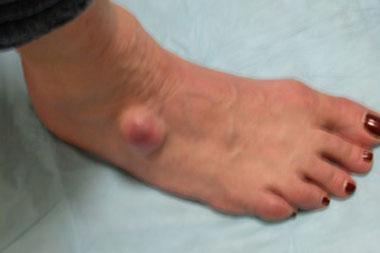 hard dry skin on top of foot